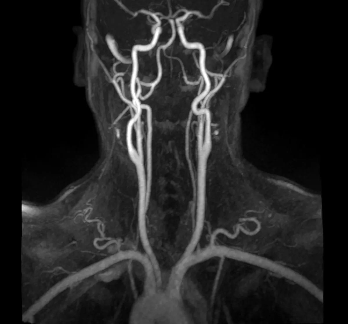 Scientists Find "Ominous" Signs of Artery Damage in Surprisingly Young Adults Magnetic resonance angiography of cerebral artery and common carotid artery. (Paul Biris/Moment/Getty
