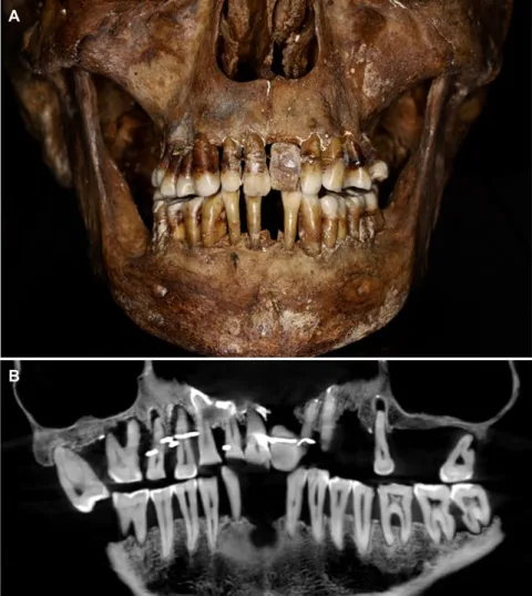 This 17th-Century Aristocrat Had an Ingenious Secret For Keeping Her Teeth A photograph (A) and cone-beam computed tomography scan (B) of d'Alègre's upper and lower jawbones. (Coll