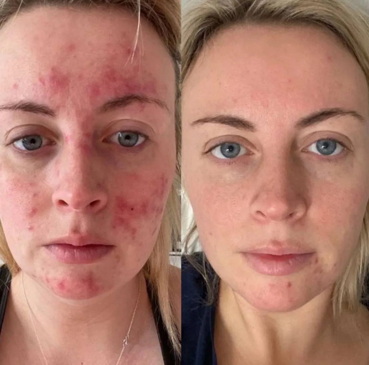 A side-by-side comparison of a woman's face, with noticeable red blemishes on the left and a clear complexion on the right.