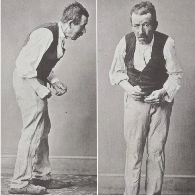 Pierre D Parkinsons Disease