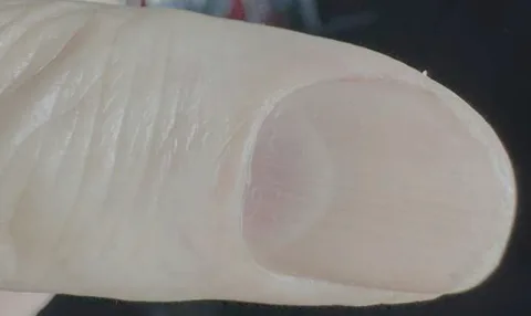 Red fingernail The reddening isn't necessarily dramatic. (Karim and Schwartz, Am. J. Med. Sci., 2026)