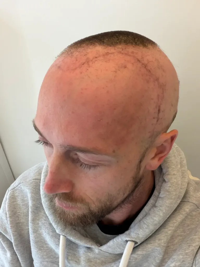Image 7: Matt had surgery to remove a percentage of the tumour in February of this year (Supplied)