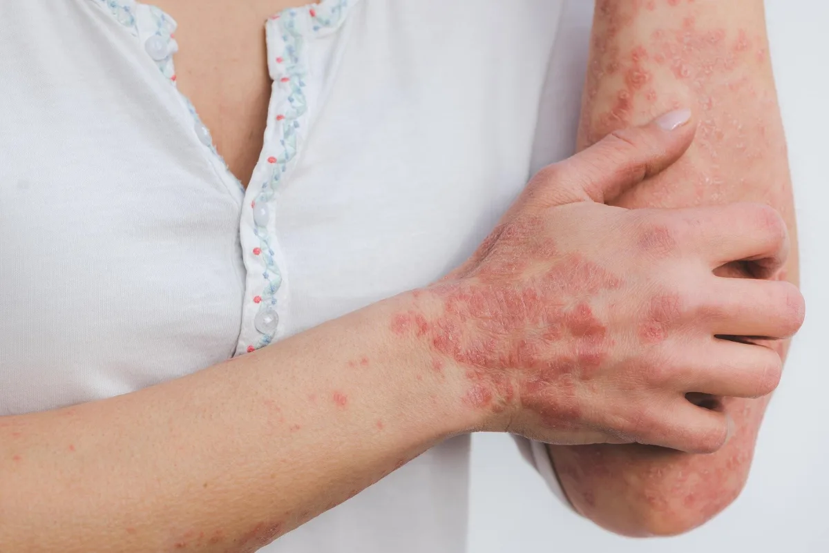 Plašā ģenētisko datu analīzē atklāti jauni psoriāzes riska mehānismi
