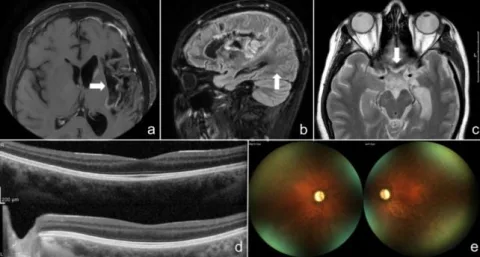 Mitochondria From a Woman's Leg Were Injected Into Her Eyes in World First Brain and eye imaging showing damage to the patient's optic nerves and retinal ganglion cells before the