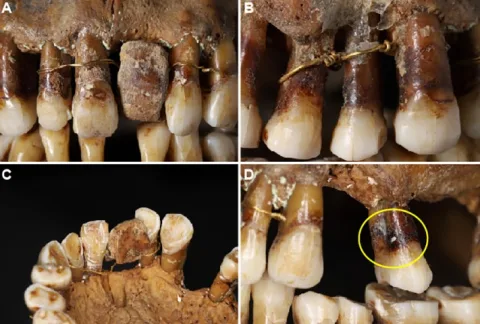 This 17th-Century Aristocrat Had an Ingenious Secret For Keeping Her Teeth Close-ups of the wire and prosthetics. Circled in D is what remains of wiring fixed to a tooth with consi