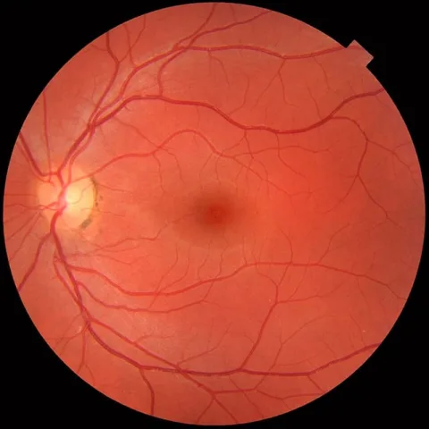 Retina scan The AI was partly tasked with identifying disease in retina scans. (Mikael Häggström/CC0 via Wikimedia Commons/Public Domain)
