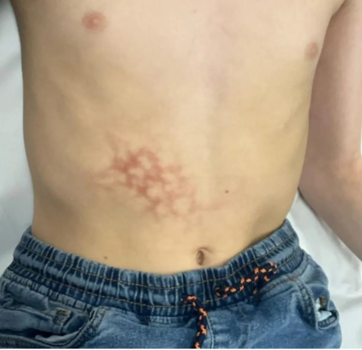 Bizarre Rash Was Thought to Be a Liver Injury, But It Was Caused by a Common Habit Abdominal markings seen during first presentation. (Znagoveanu & Artley, BMJ Case Reports, 2026)